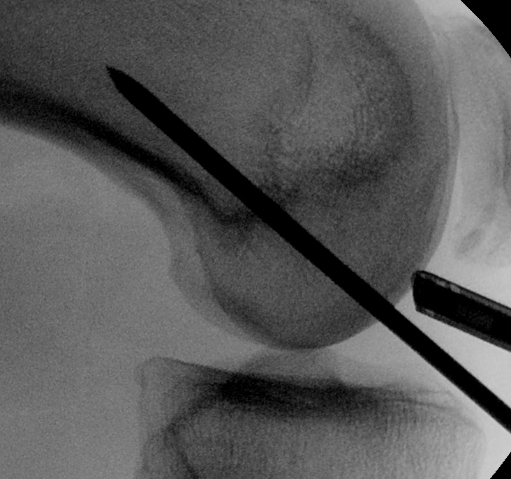 Lars ACL Femoral Entry Point 2